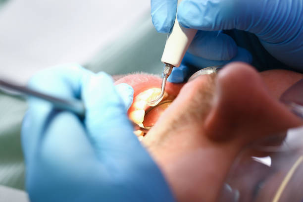 Best Emergency Wisdom Tooth Extraction in North Fork, CA